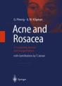 Acne And Rosacea - Preview