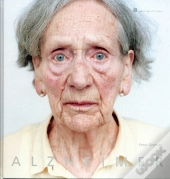 Alzheimer