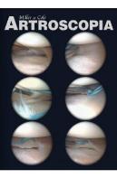 Artroscopia