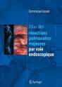 Atlas Des Résections Pulmonaires Majeures Par Voie Endoscopique - Preview