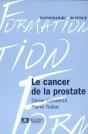 Cancer De La Prostate - Preview