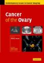 Cancer Of The Ovary - Preview