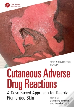 Capa do artigo Cutaneous Adverse Drug Reactions