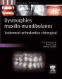 Dysmorphies Maxillo-Mandibulaires ; Traitement Orthodontico-Chirurgical - Preview