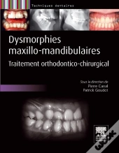 Dysmorphies Maxillo-Mandibulaires ; Traitement Orthodontico-Chirurgical