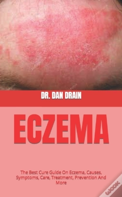 Capa do artigo Eczema