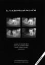 El Tercer Molar Incluido - Preview