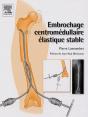 Embrochage Centromédullaire Élastique Stable - Preview