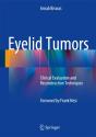 Eyelid Tumors - Preview