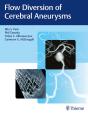 Flow Diversion Of Cerebral Aneurysms - Preview
