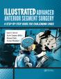 Illustrated Advanced Anterior Segment Surgery - Preview