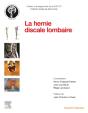 La Hernie Discale Lombaire - Preview
