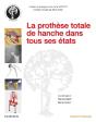 La Prothèse Totale De Hanche Dans Tous Ses États - Preview