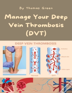 Capa do artigo Manage Your Deep Vein Thrombosis (Dvt)