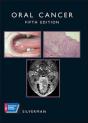 Oral Cancer - Preview