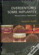 Overdentures Sobre Implantes - Manual Clínico e Laboratorial