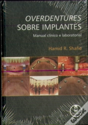 Capa do artigo Overdentures Sobre Implantes - Manual Clínico e Laboratorial