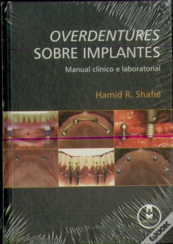 Capa do artigo Overdentures Sobre Implantes - Manual Clínico e Laboratorial