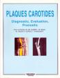 Plaques Carotides - Preview