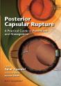 Posterior Capsular Rupture - Preview