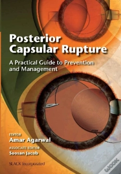 Capa do artigo Posterior Capsular Rupture