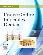 Prótese sobre Implantes Dentais