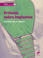 Prótesis Sobre Implantes - Preview