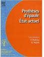 Prothèse D'Épaule ; État Actuel - Preview