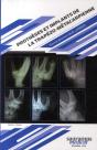 Prothèses Et Implants De La Trapézo Métacarpienne - Preview