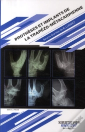 Prothèses Et Implants De La Trapézo Métacarpienne