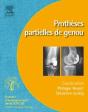 Prothèses Partielles Du Genou - Preview