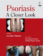 Psoriasis - Preview