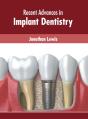 Recent Advances In Implant Dentistry - Preview
