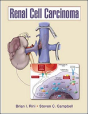 Renal Cell Carcinoma - Preview