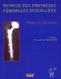 Reprise Des Prothèses Fémorales Descellées - Preview