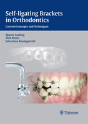 Self-Ligating Brackets In Orthodontics - Preview