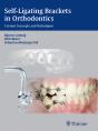 Self-Ligating Brackets In Orthodontics - Preview