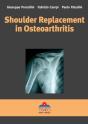 Shoulder Replacement In Osteoarthritis - Preview