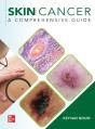 Skin Cancer: A Comprehensive Guide - Preview