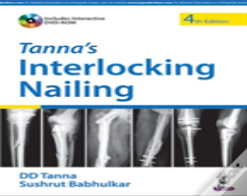 Tanna'S Interlocking Nailing