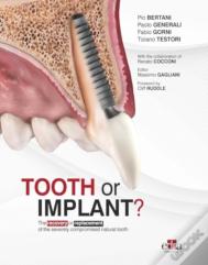 Tooth Or Implant