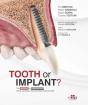 Tooth Or Implant - Preview