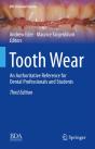 Tooth Wear - Preview