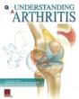 Understanding Arthritis Flip Chart - Preview