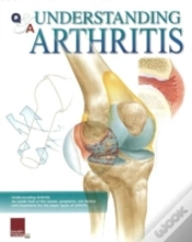 Capa do artigo Understanding Arthritis Flip Chart